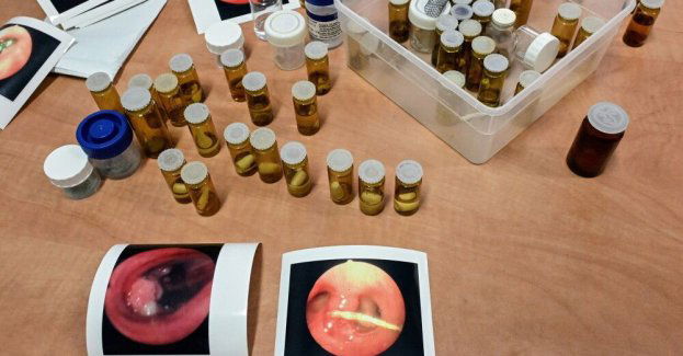 Szpital zaprezentował przedmioty wyciągnięte z oskrzeli pacjentów, m.in. gwoździe