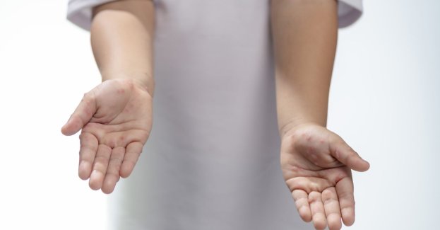 Lekarze ostrzegają przed chorobą brudnych rąk