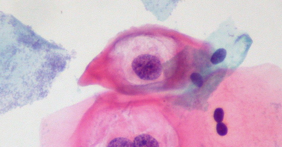 zdjęcie: Światowa świadomość HPV: razem przeciwko zagrożeniu / By Ed Uthman, MD - https://www.flickr.com/photo_zoom.gne?id=384102992&size=o [CC BY-SA 2.0 DEED (https://creativecommons.org/licenses/by-sa/2.0/)], via Wikimedia Commons