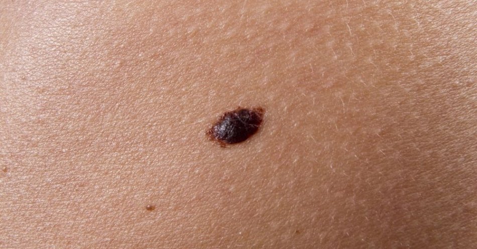 zdjęcie: Rak skóry błędnie kojarzony jest głównie z czerniakiem / fot. PAP